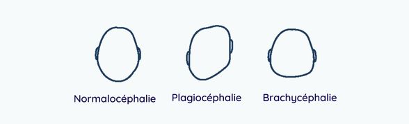 Explication de la plagiocéphalie